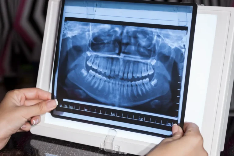 Common Misconceptions and Myths About Dental X-Rays