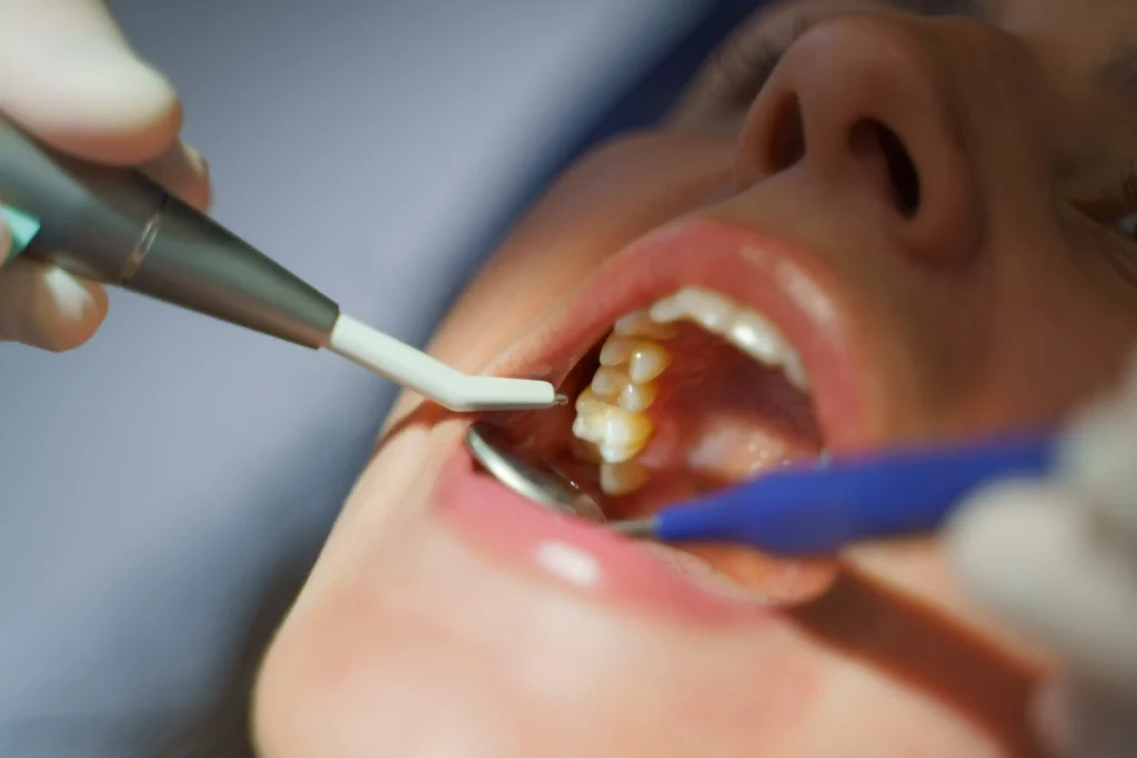 Dental Cleaning, close up of dental examination in the ambulance